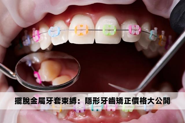 擺脫金屬牙套束縛：隱形牙齒矯正價格大公開