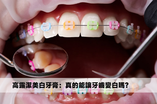 高露潔美白牙膏：真的能讓牙齒變白嗎？